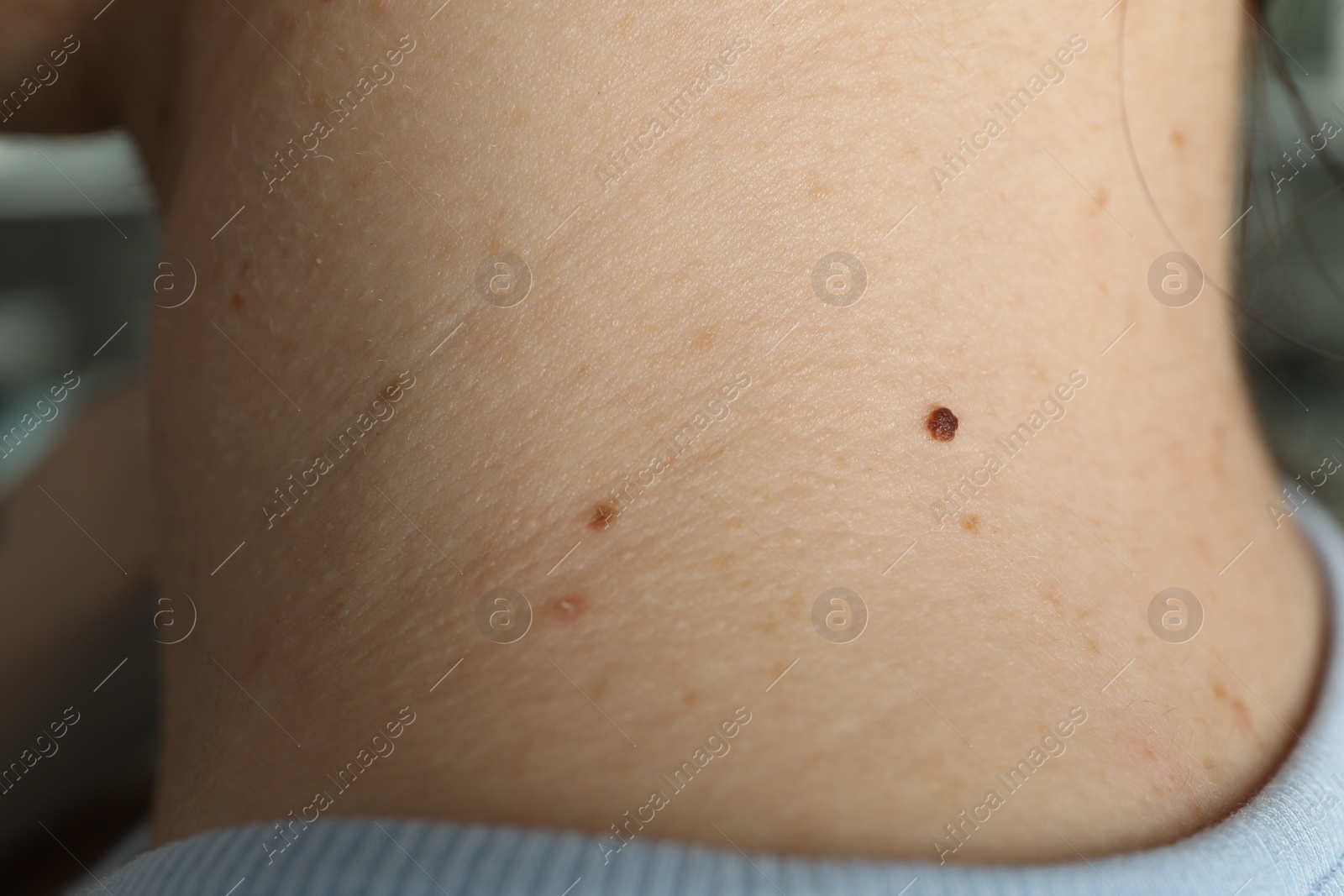 Photo of Closeup view of woman's body with birthmarks