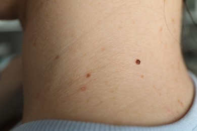 Photo of Closeup view of woman's body with birthmarks