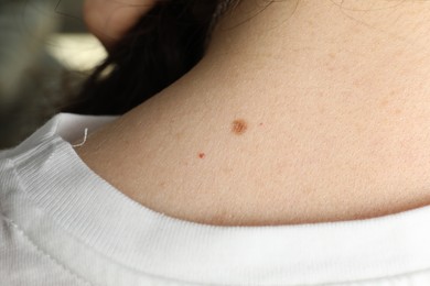 Closeup view of woman's body with birthmarks