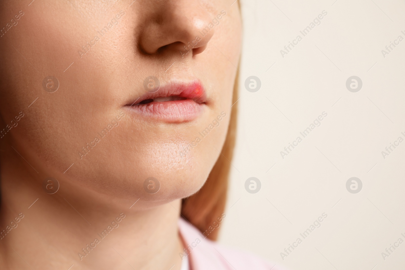 Photo of Woman suffering from herpes on beige background, closeup. Space for text