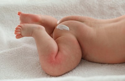 Image of Cute little baby with anti-allergic cream on body indoors, closeup. Redness on skin