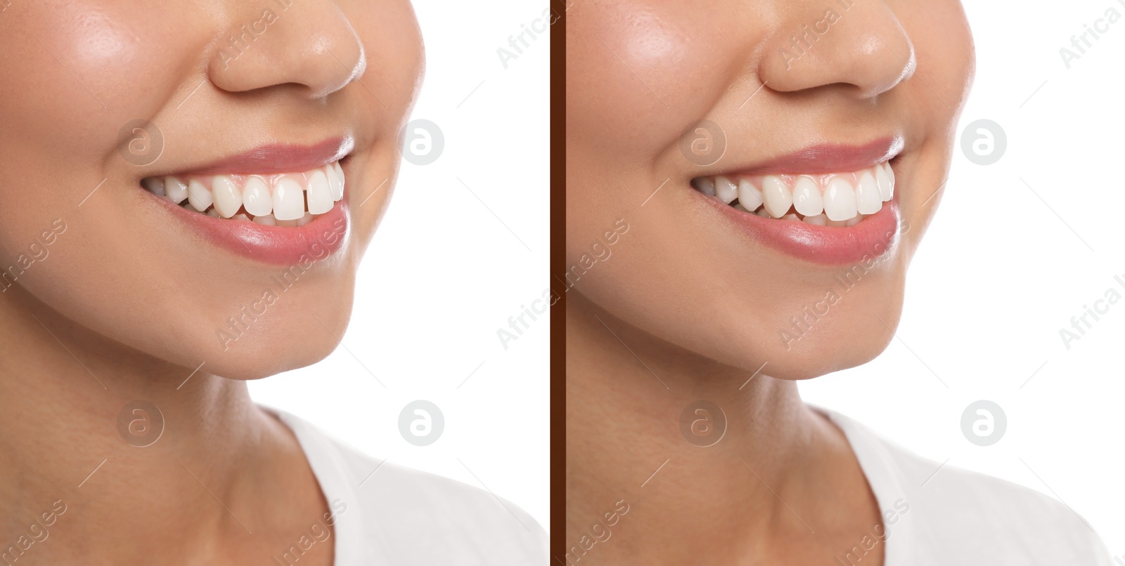 Image of Collage with photos of woman with diastema between upper front teeth before and after treatment on white background, closeup. Banner design