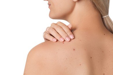 Closeup of woman`s body with birthmarks on white background, back view