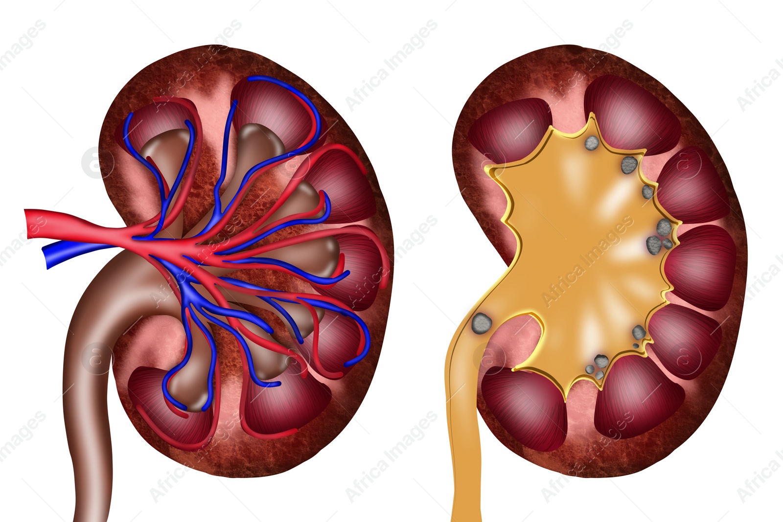 Illustration of  healthy and diseased kidneys on white background