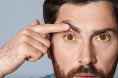 Photo of Man with yellow eyes on grey background, closeup. Symptom of hepatitis