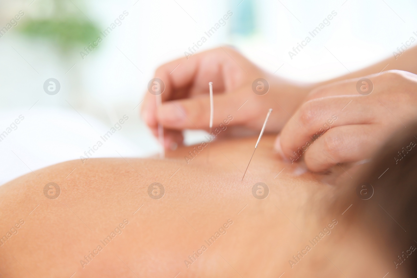 Photo of Young woman undergoing acupuncture treatment in salon, closeup