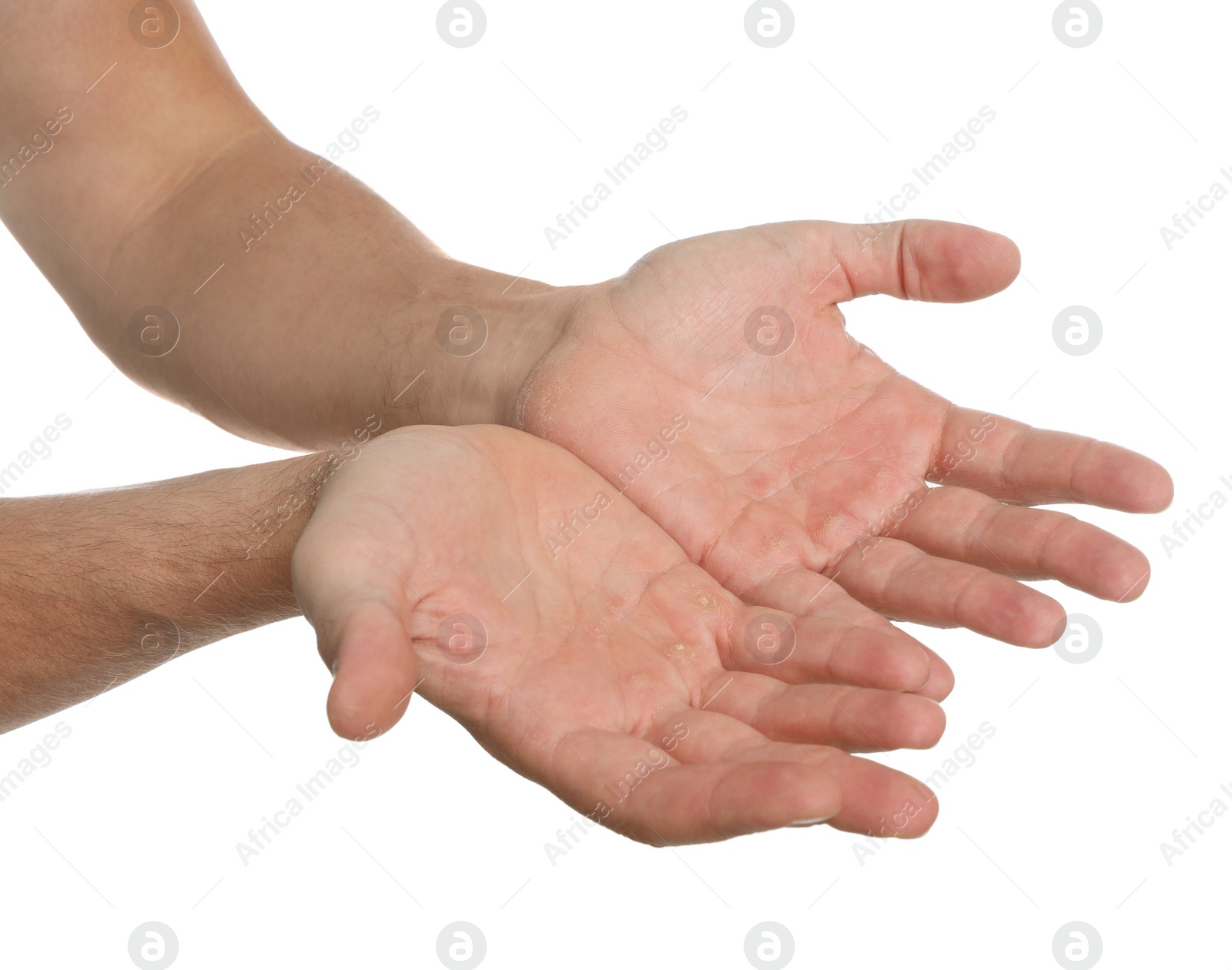 Photo of Man suffering from calluses on hands against white background, closeup