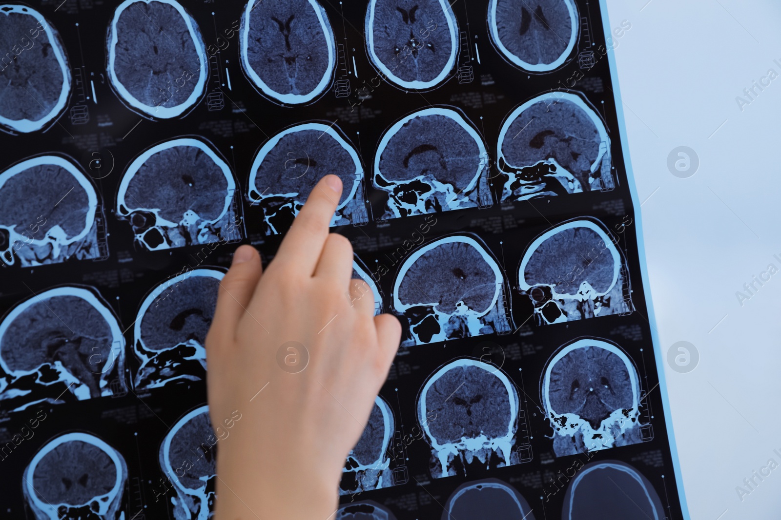 Photo of Doctor examining MRI images of patient with multiple sclerosis in clinic, closeup