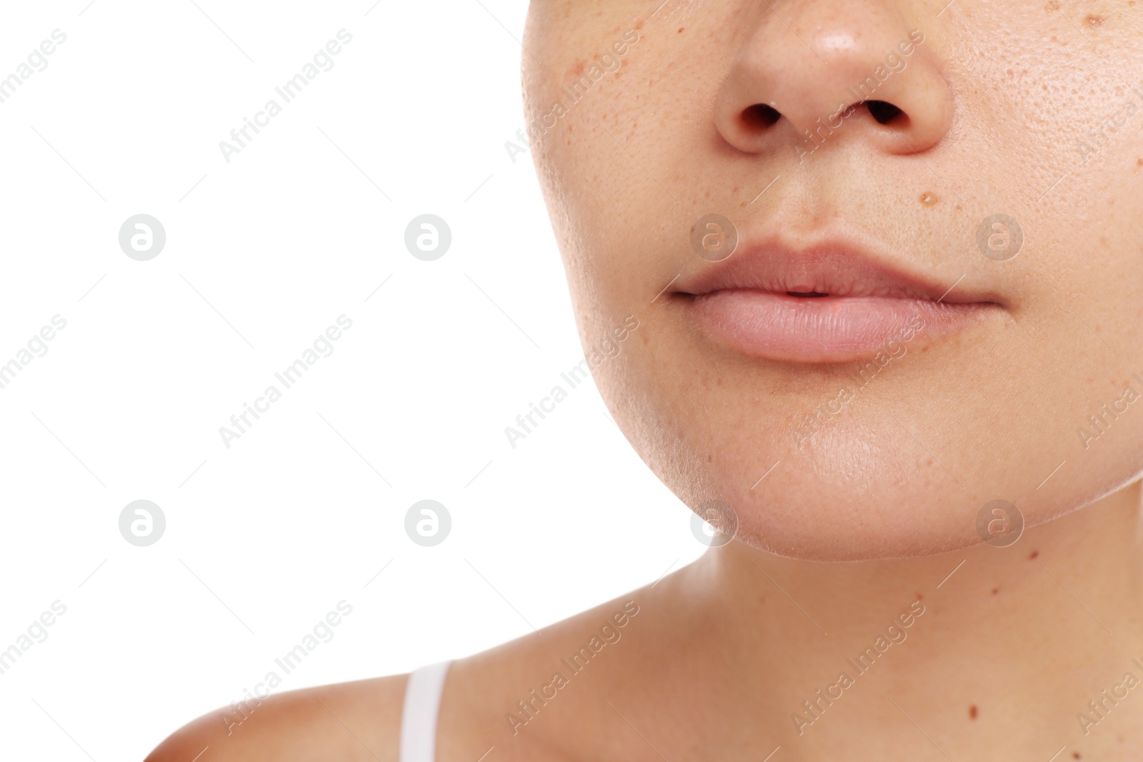 Photo of Closeup view of woman`s face with birthmarks on white background