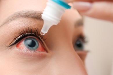 Image of Closeup view of woman with inflamed eyes using drops