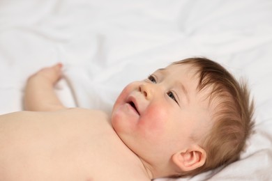 Photo of Cute little baby with diathesis symptom on bed indoors