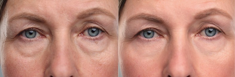 Image of Aging skin changes. Collage with photos of mature woman before and after cosmetic procedure, closeup