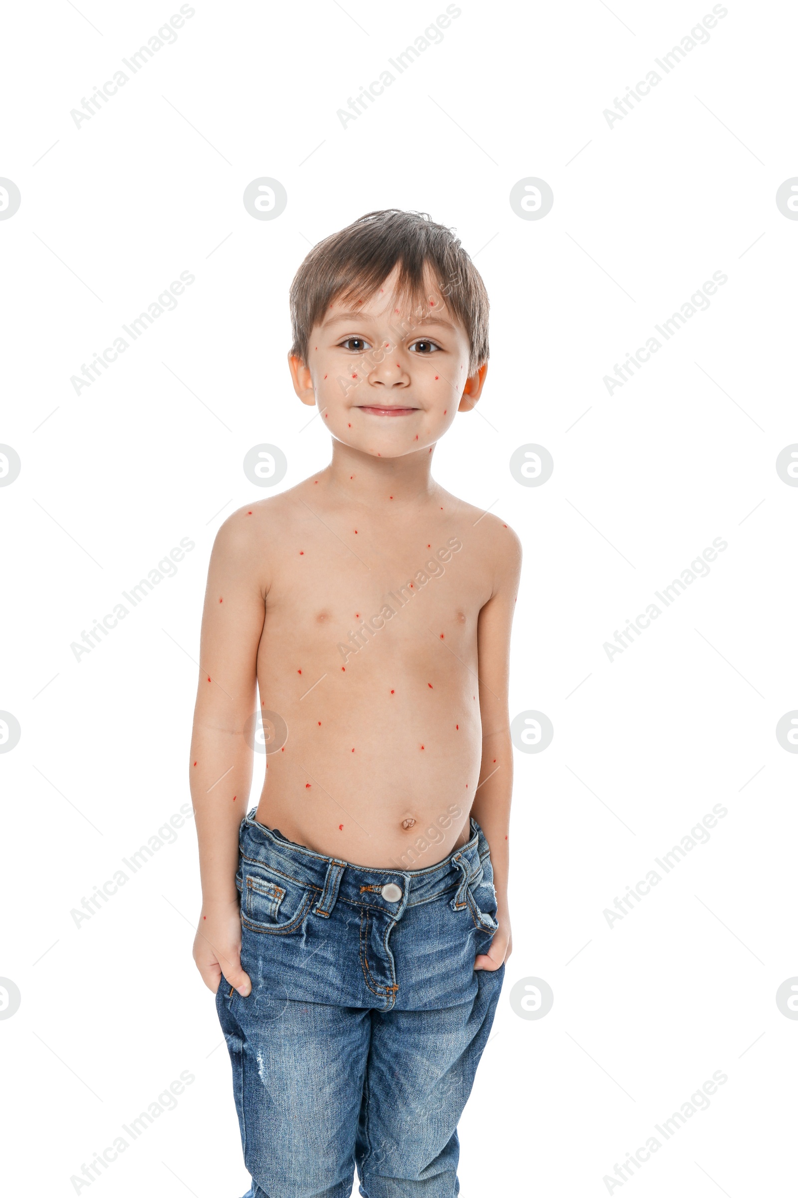 Photo of Little boy with chickenpox on white background. Varicella zoster virus