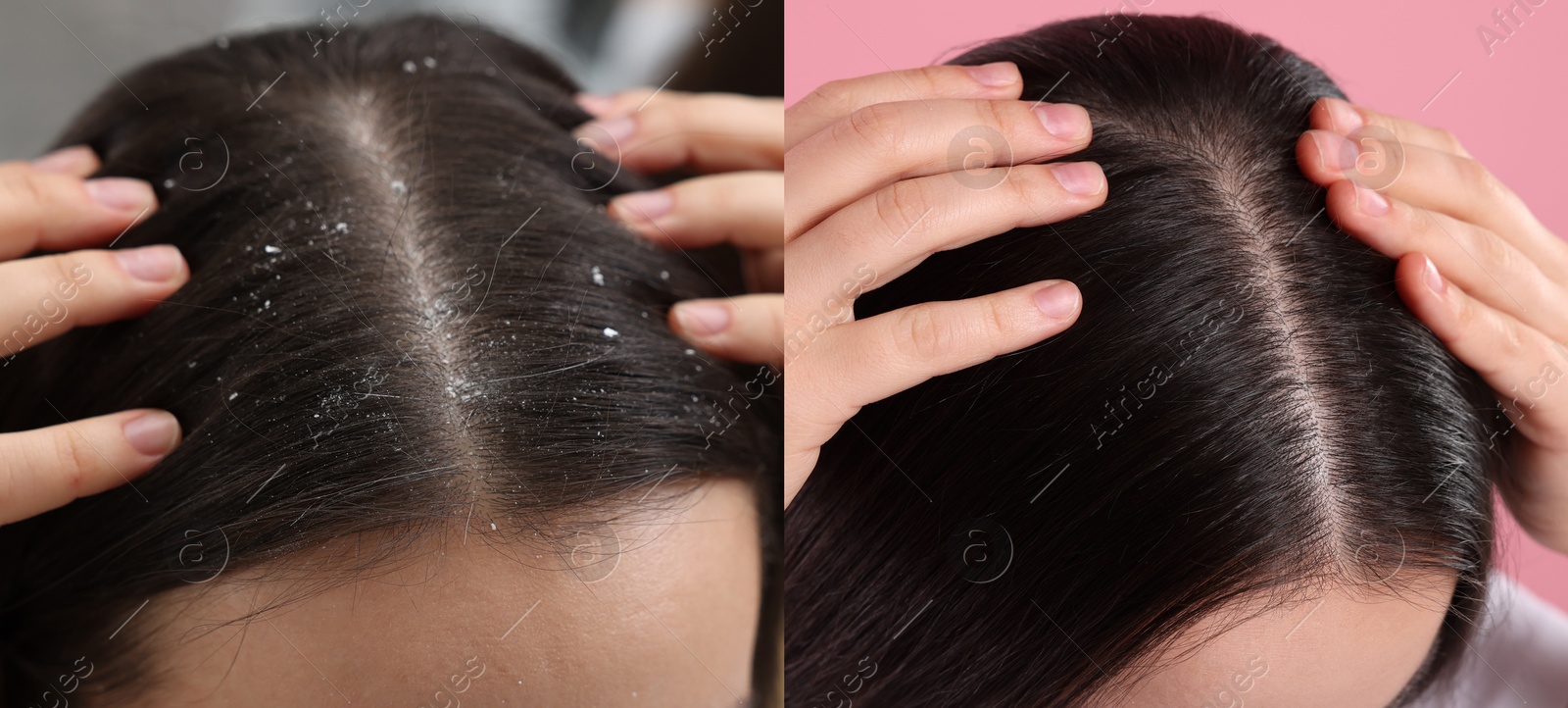 Image of Woman showing hair before and after dandruff treatment, collage