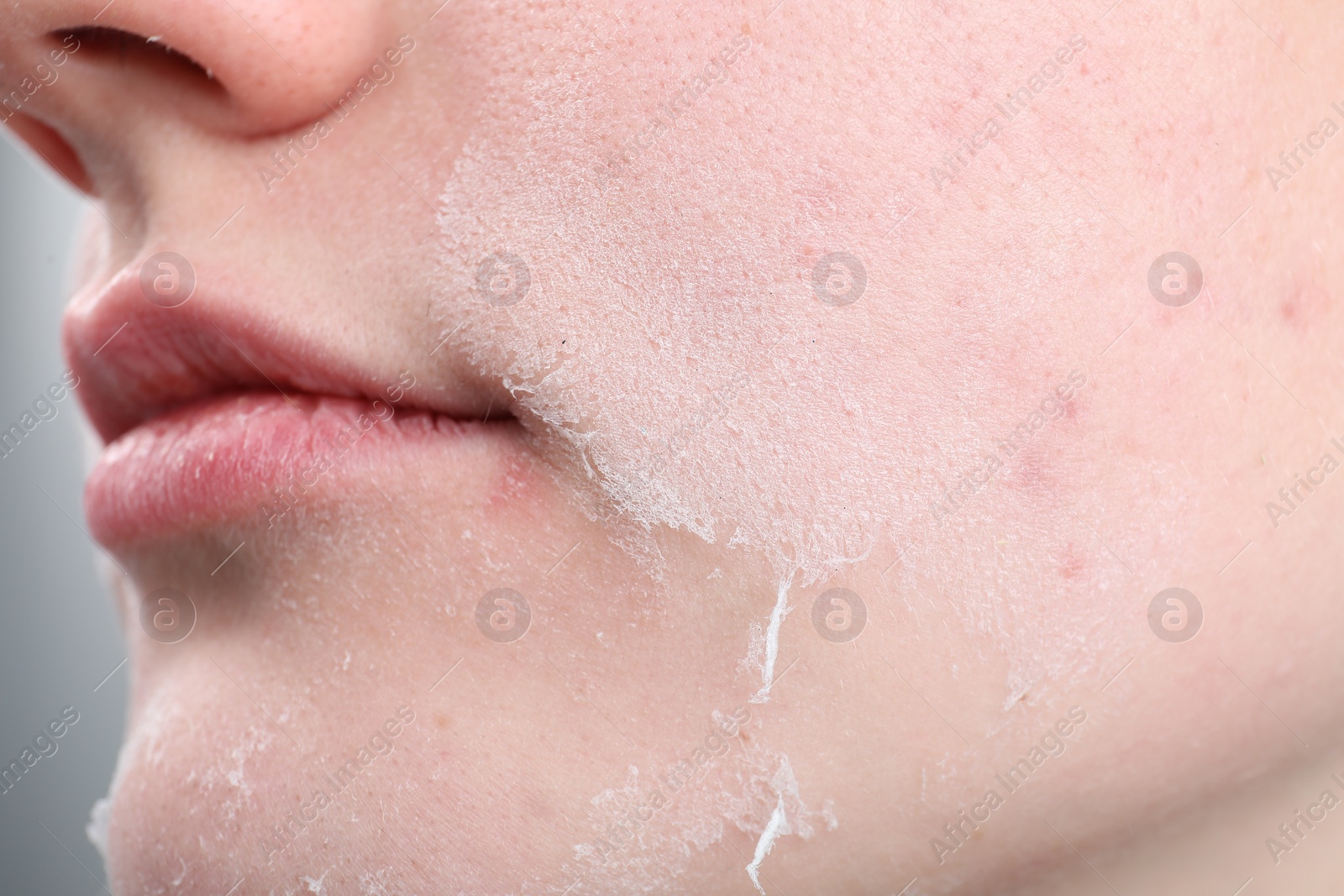 Photo of Woman with dry skin on face, closeup