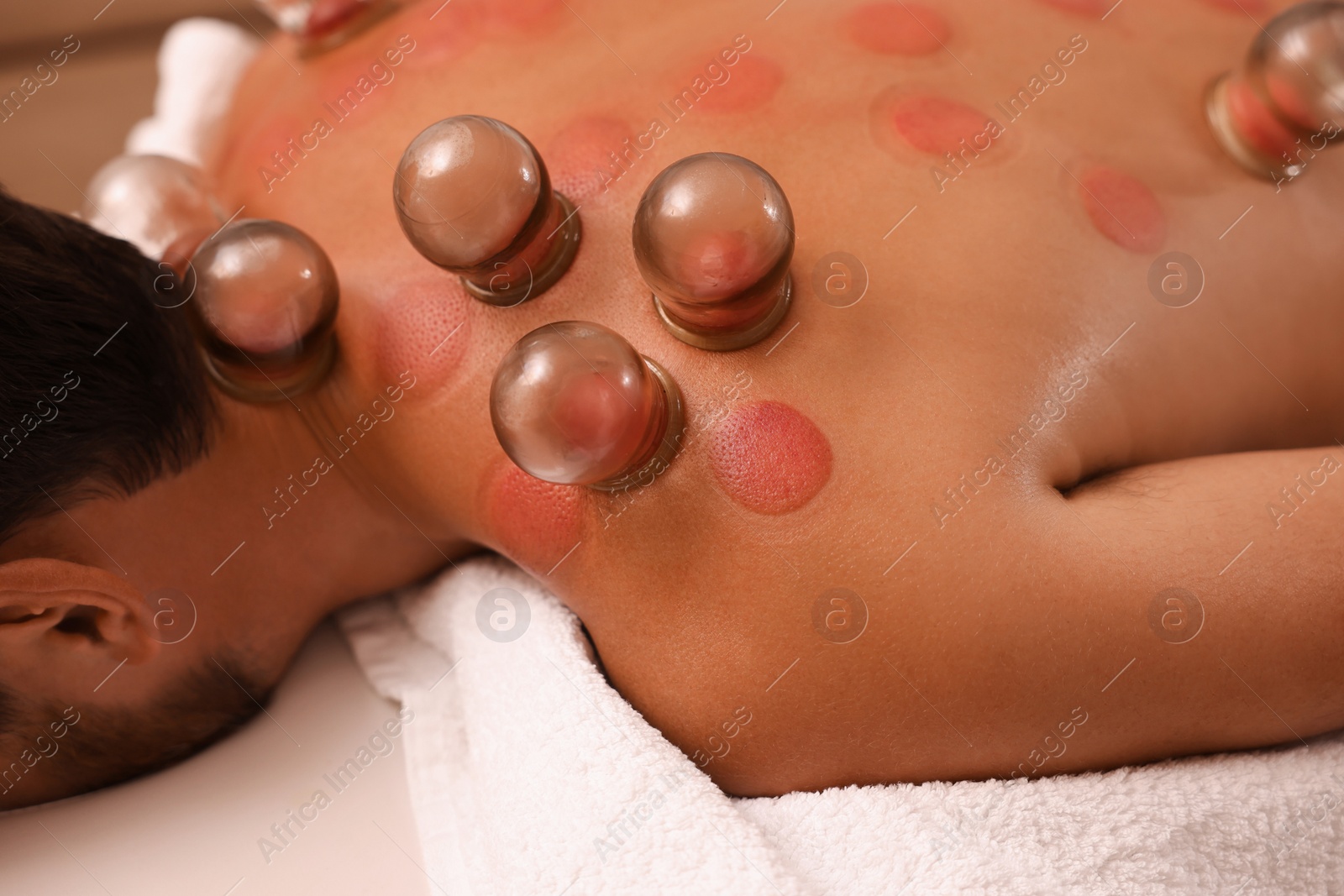 Photo of Cupping therapy. Closeup view of man with glass cups on his back indoors