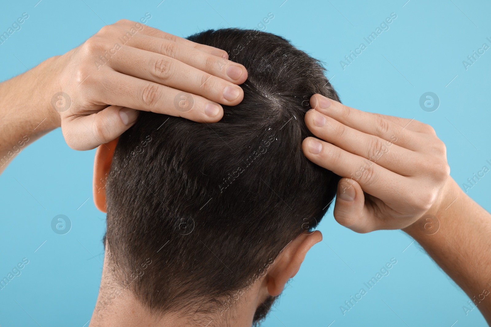 Photo of Man with dandruff in his dark hair on light blue background, back view