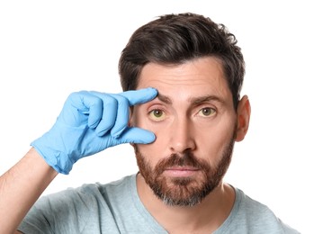 Doctor checking man with yellow eyes on white background. Symptom of hepatitis
