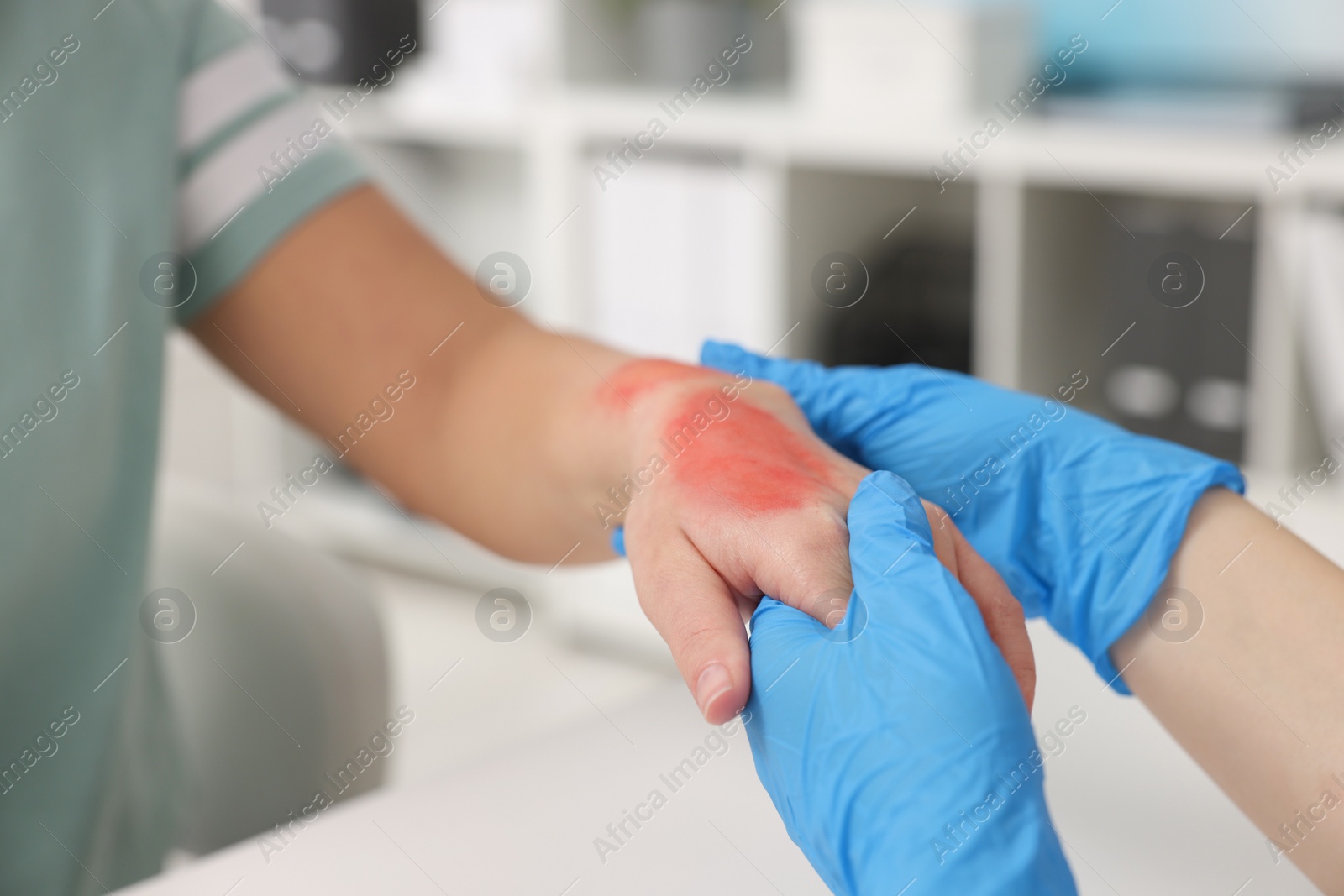 Photo of Doctor examining patient's burned hand indoors, closeup