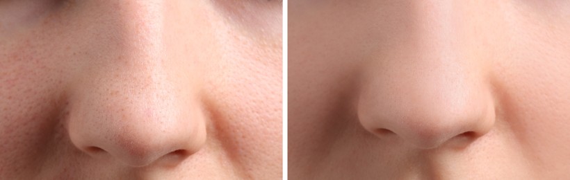 Photos of woman before and after acne treatment, closeup. Collage showing affected and healthy skin