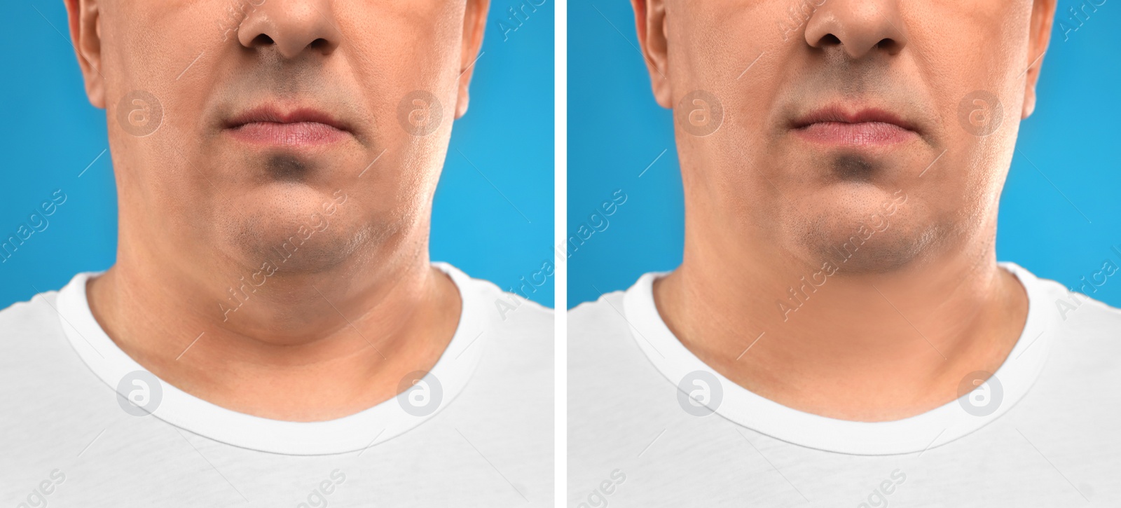 Image of Mature man before and after plastic surgery operation on blue background, closeup. Double chin problem