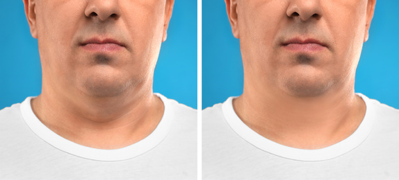 Image of Mature man before and after plastic surgery operation on blue background, closeup. Double chin problem