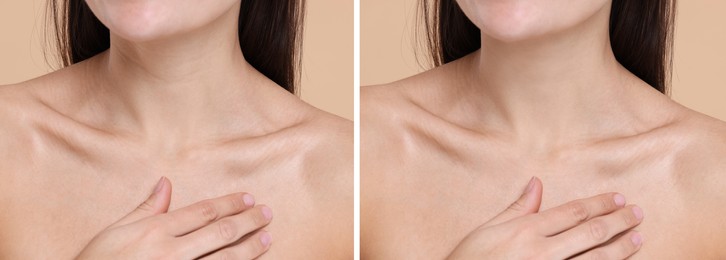 Image of Aging skin changes. Woman showing neck before and after rejuvenation, closeup. Collage comparing skin condition