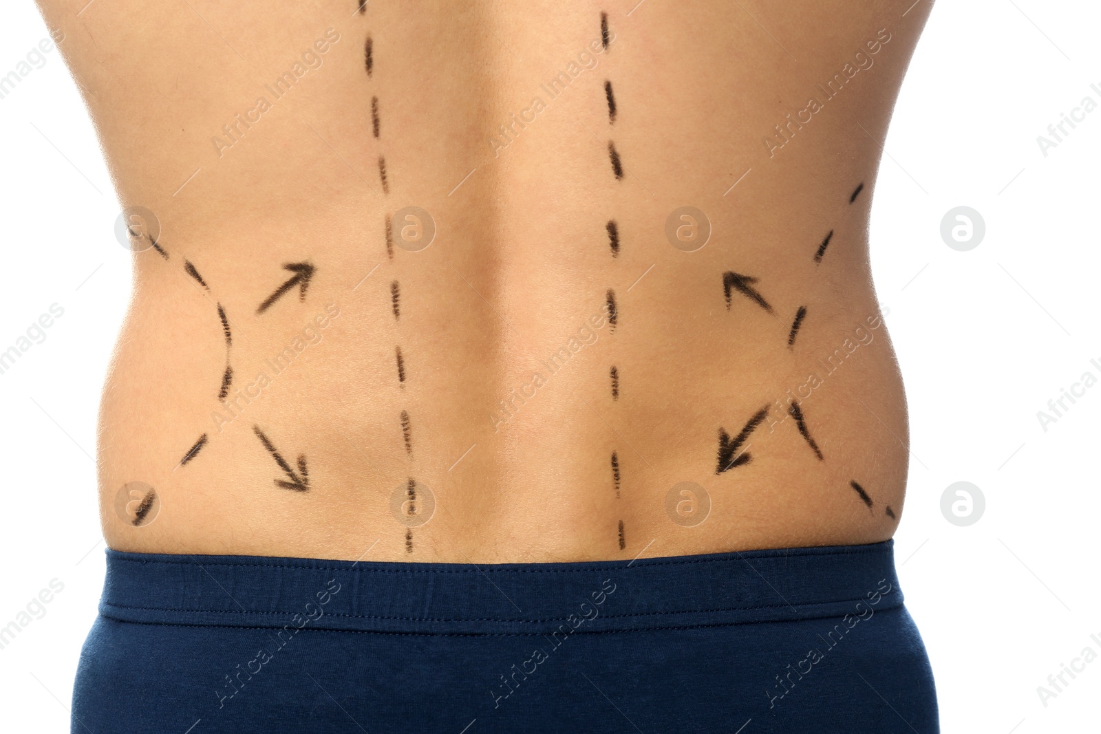 Photo of Young man with marks on body for cosmetic surgery operation against white background, closeup