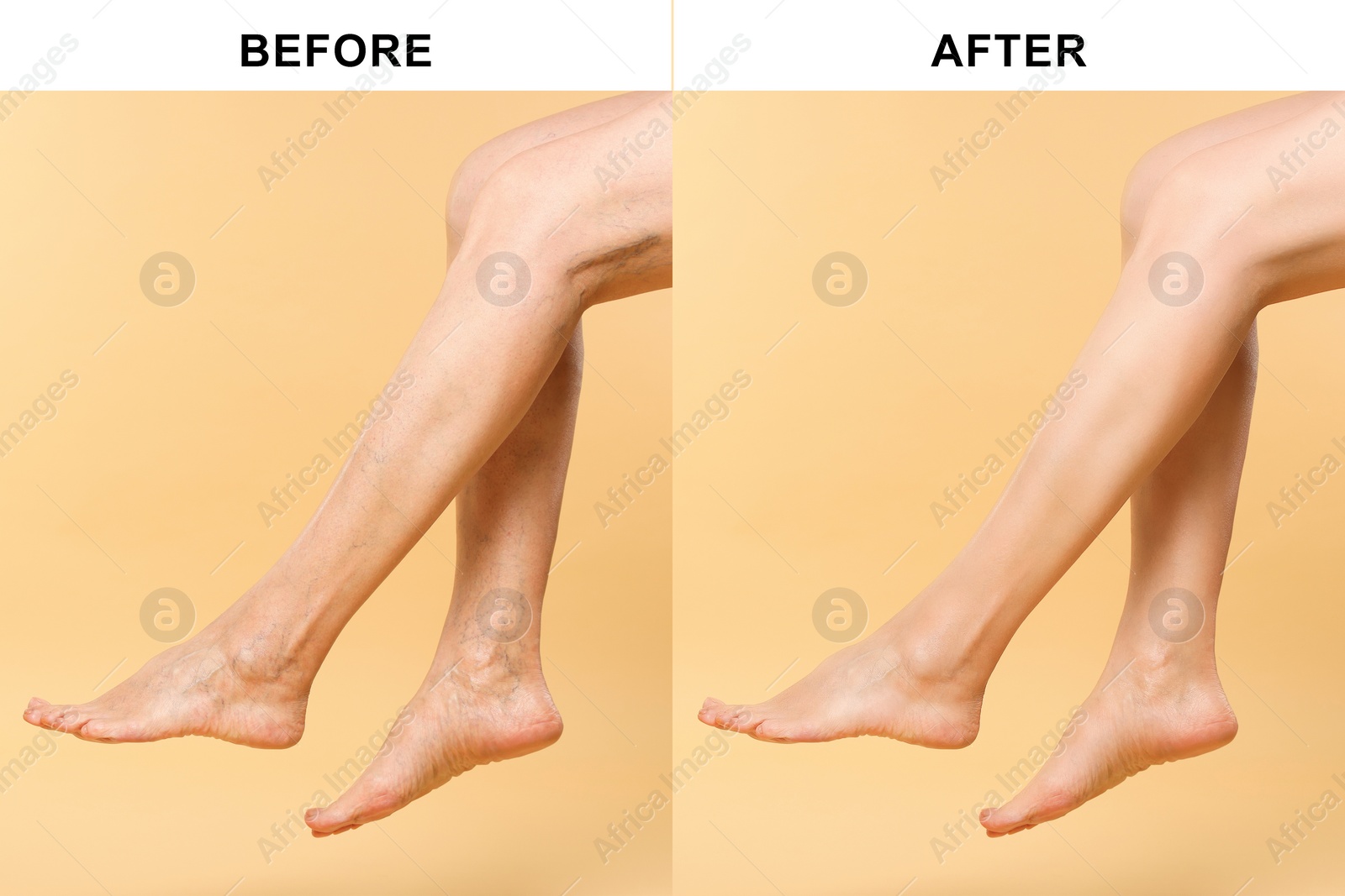 Image of Before and after varicose veins treatment. Collage with photos of woman showing legs on yellow background, closeup