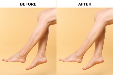 Image of Before and after varicose veins treatment. Collage with photos of woman showing legs on yellow background, closeup