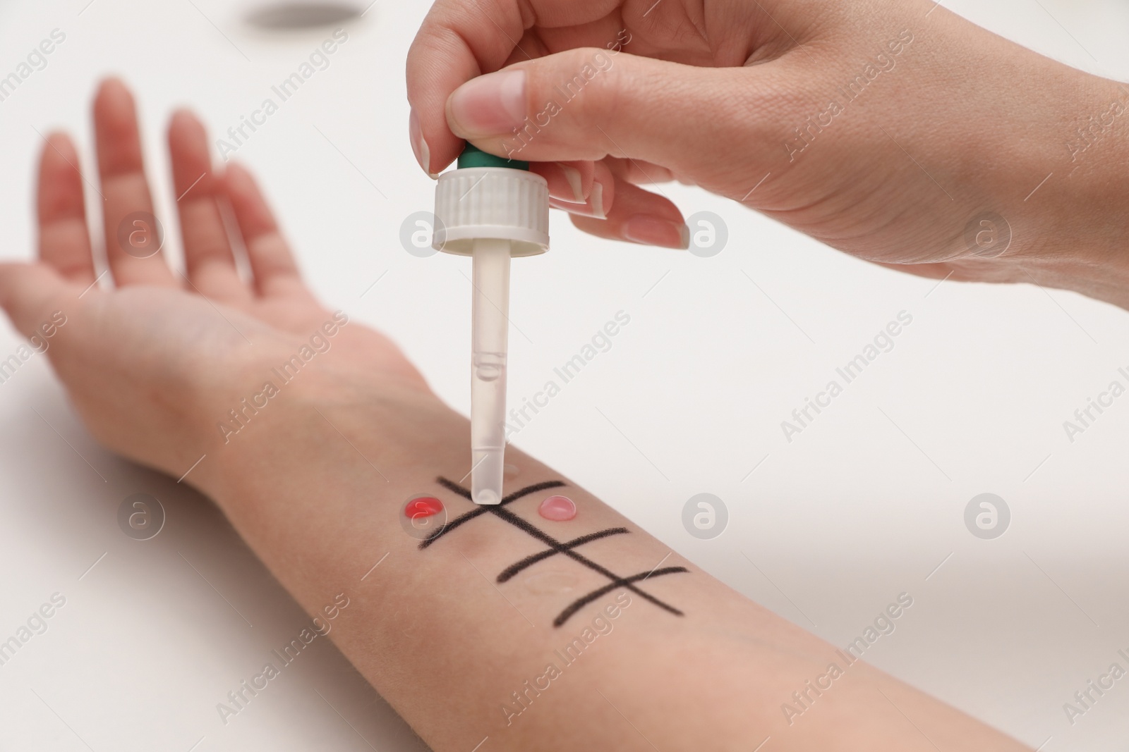 Photo of Patient undergoing skin allergy test at light table, closeup