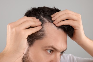 Man with dandruff in his dark hair on light gray background, closeup