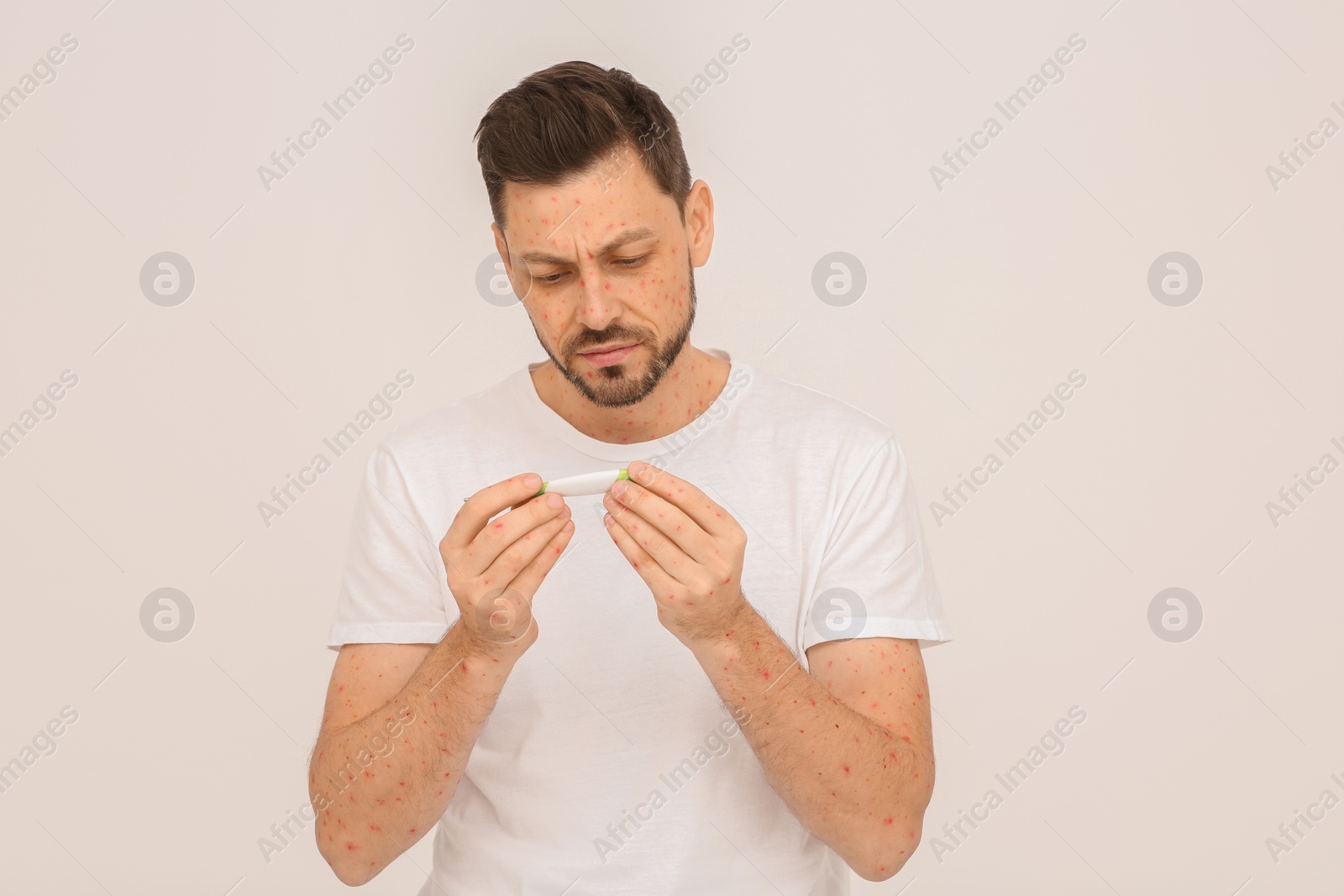 Photo of Man with rash holding thermometer on beige background. Monkeypox virus diagnosis