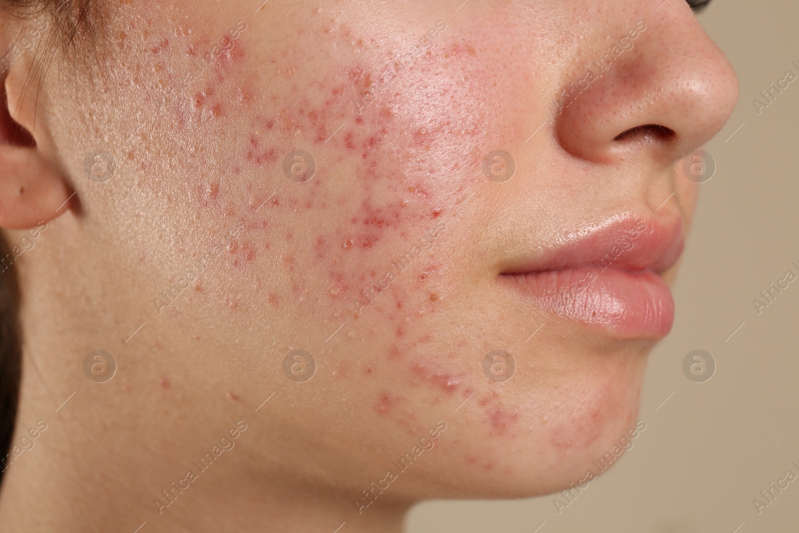 Photo of Teenage girl with acne problem on beige background, closeup