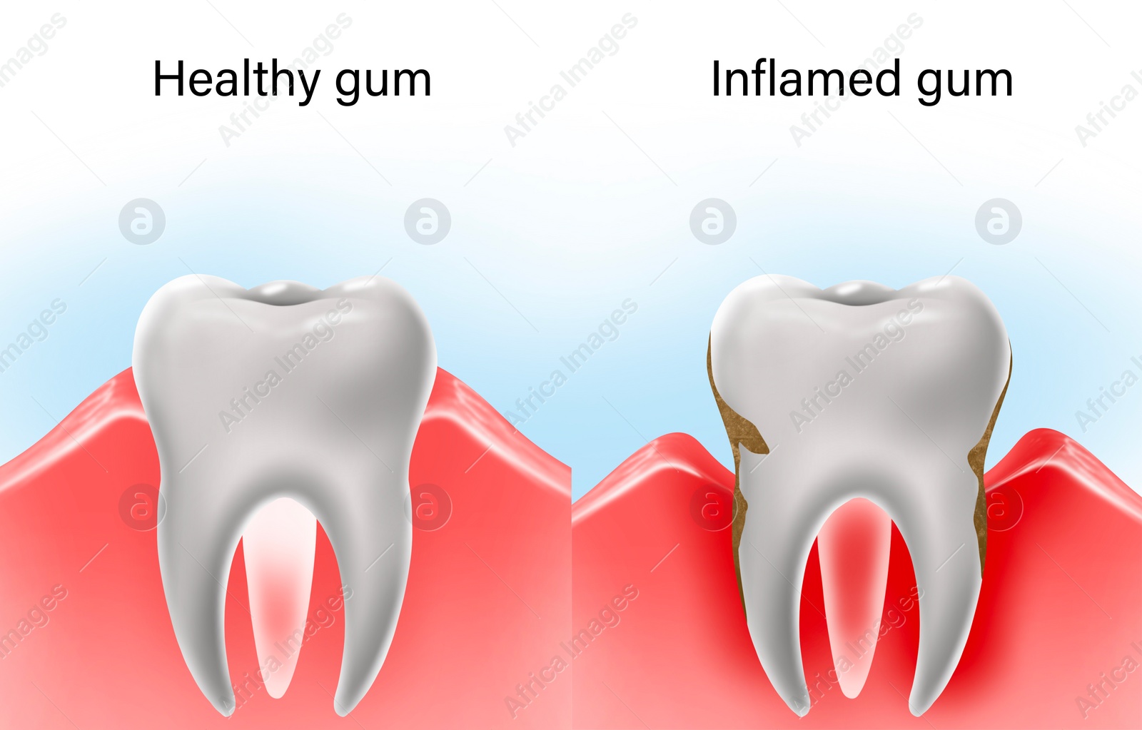 Illustration of Collage with illustrations of healthy tooth with gum and diseased ones. Gingivitis and periodontitis