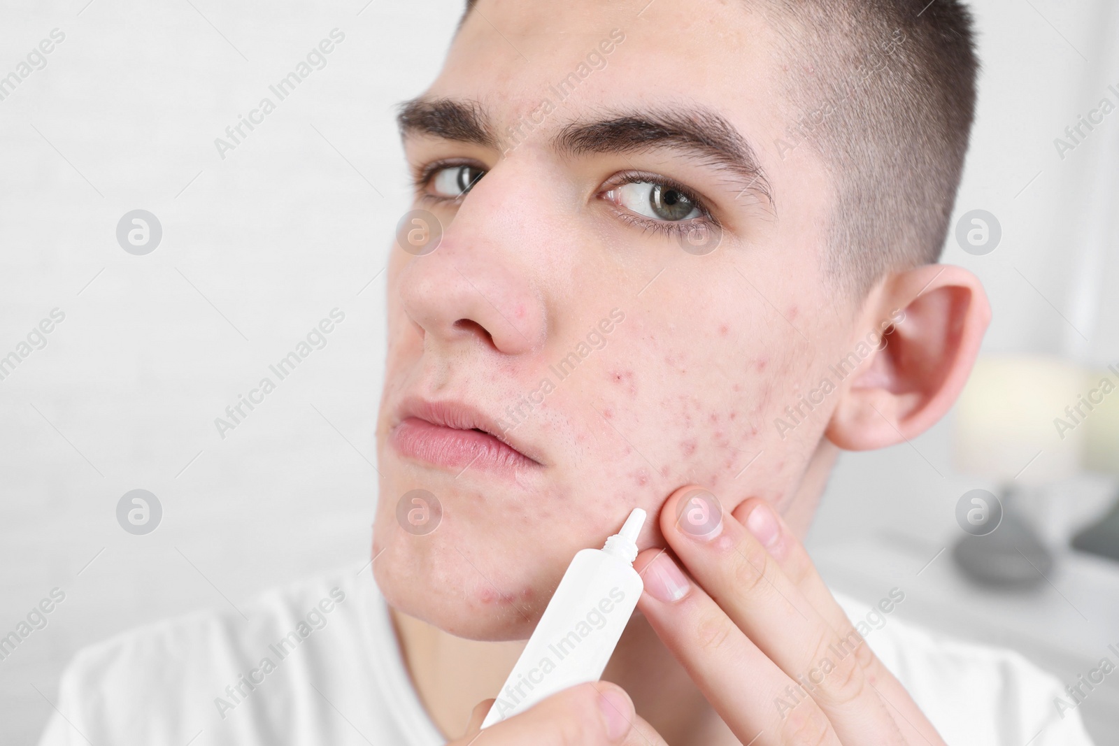 Photo of Young man with acne problem applying cosmetic product onto his skin indoors