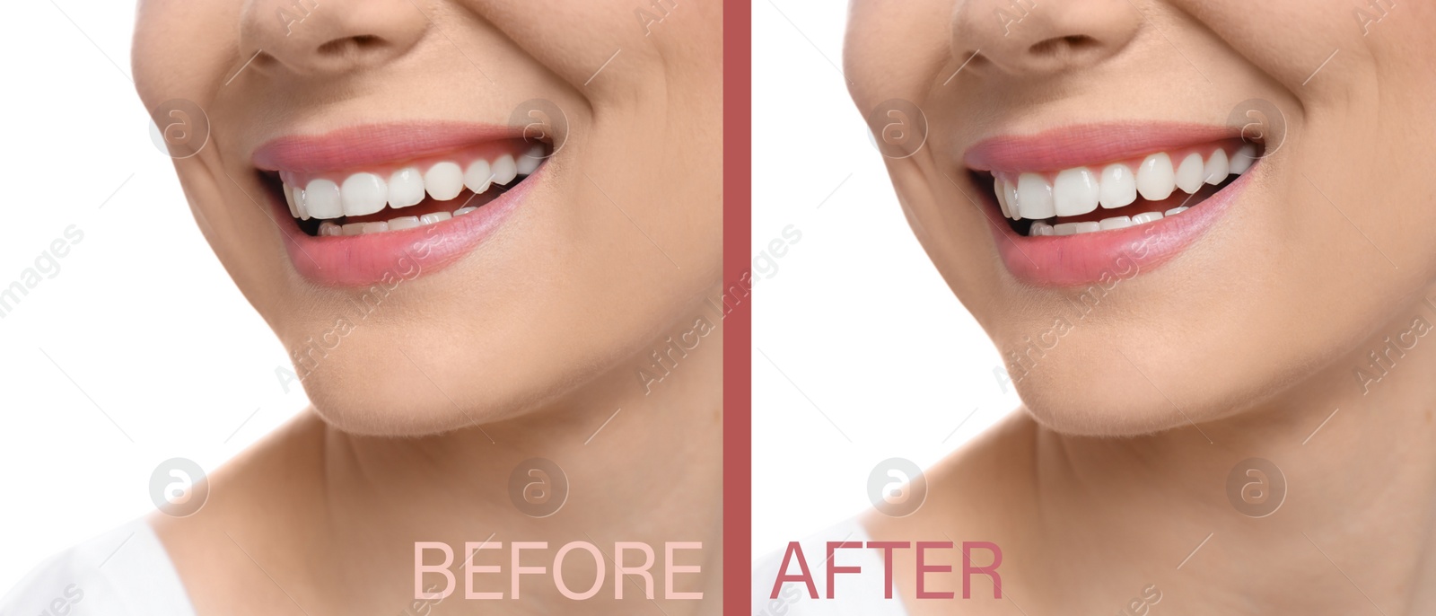 Image of Woman before and after gingivoplasty procedure on white background, closeup. Banner design