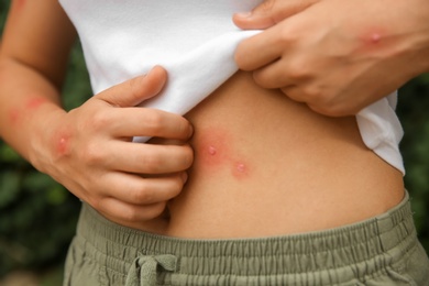 Photo of Woman scratching abdomen with insect bites outdoors, closeup