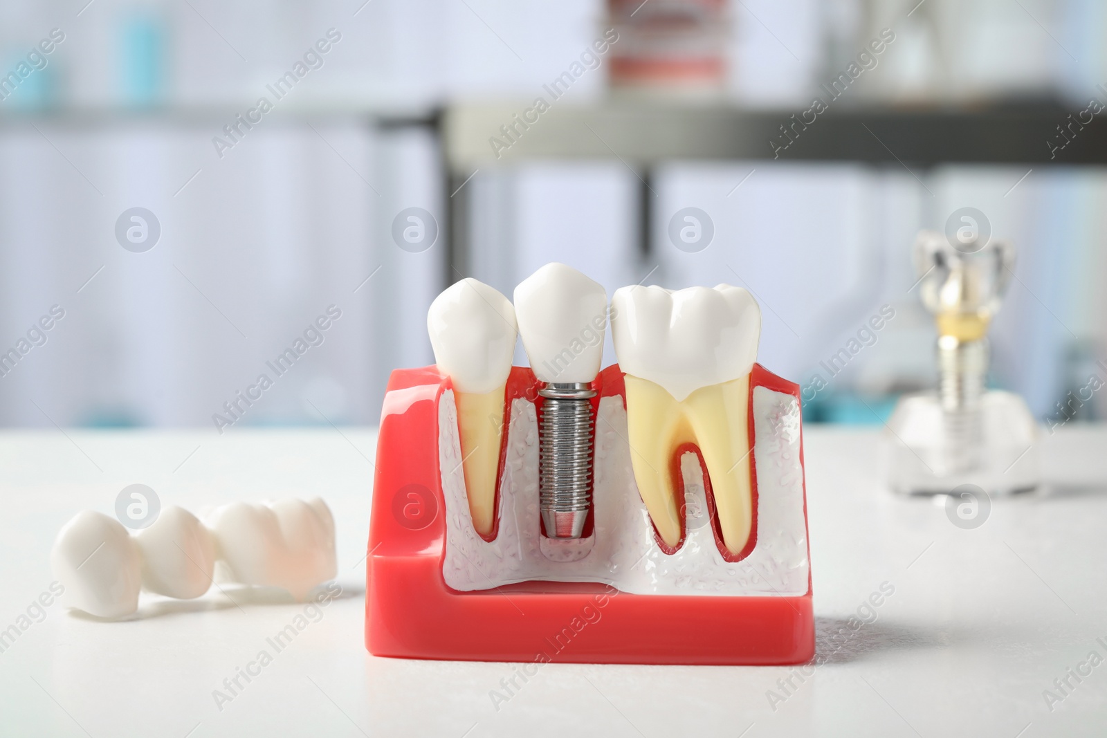Photo of Educational model of gum with dental implant between teeth on white table indoors