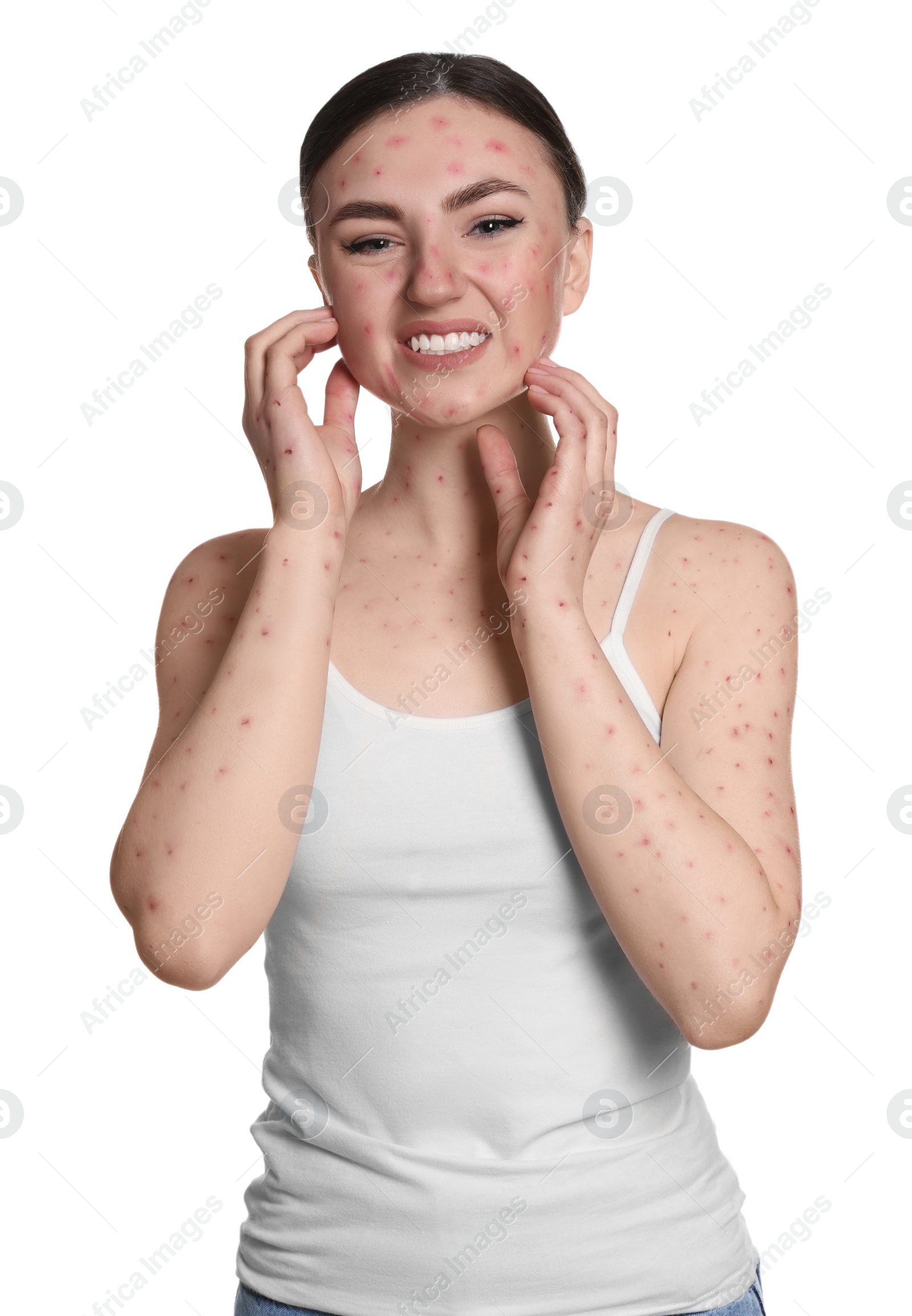 Photo of Woman with rash suffering from monkeypox virus on white background