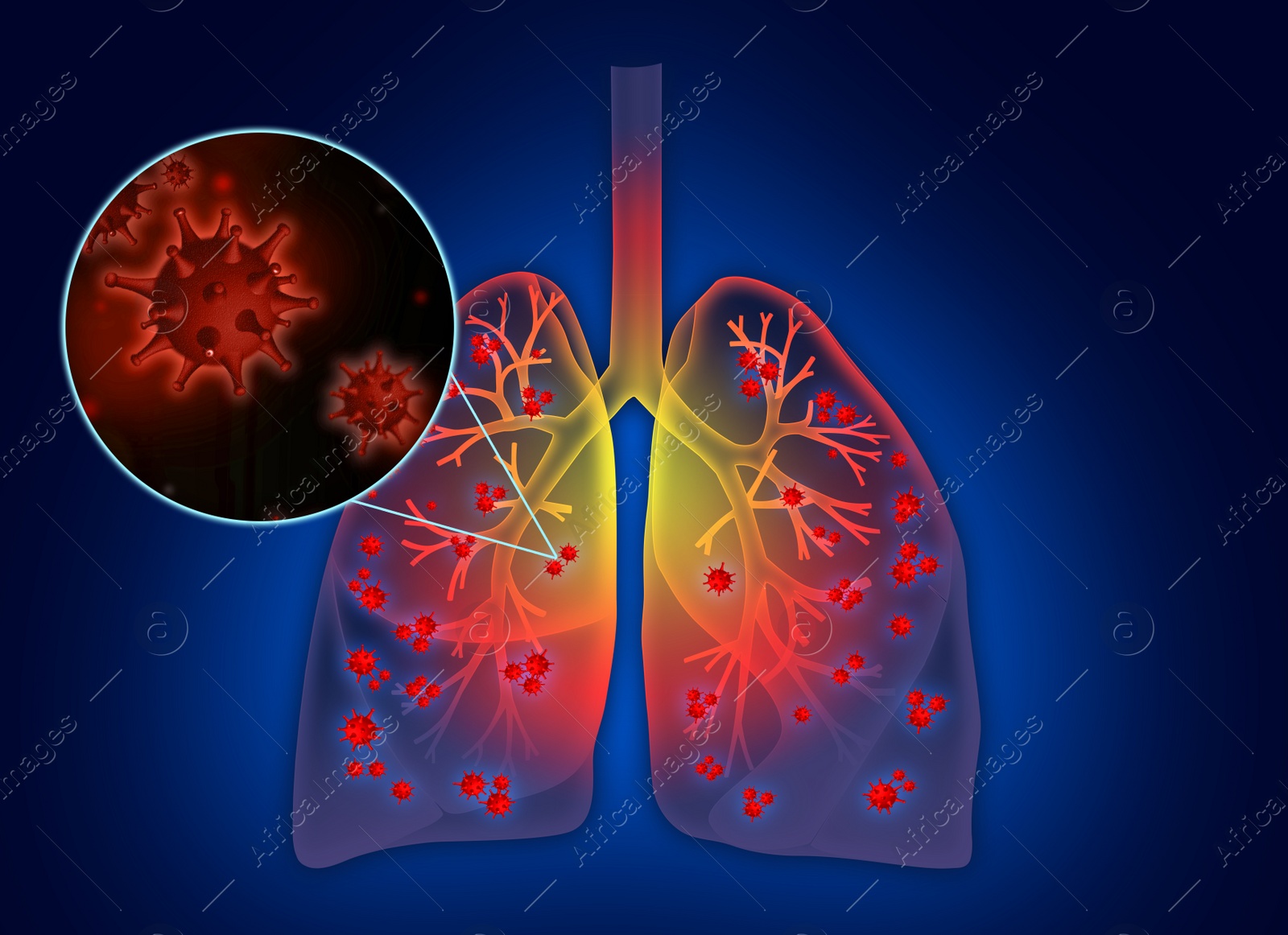 Illustration of  human lungs affected with disease on blue background