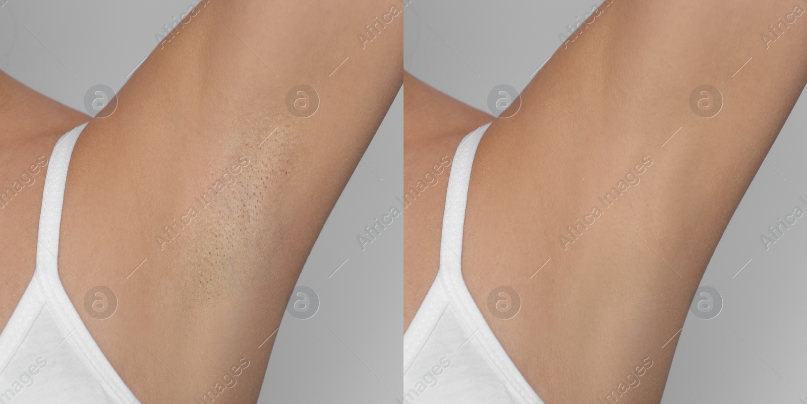 Image of Before and after epilation. Collage with photos of woman showing armpit on light background, closeup