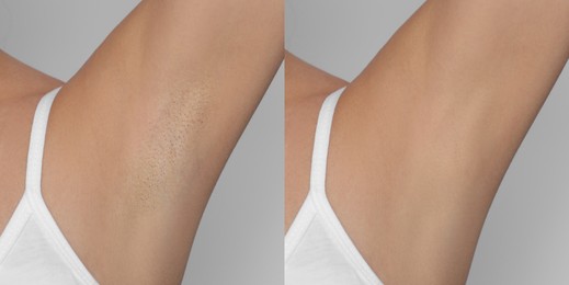 Before and after epilation. Collage with photos of woman showing armpit on light background, closeup
