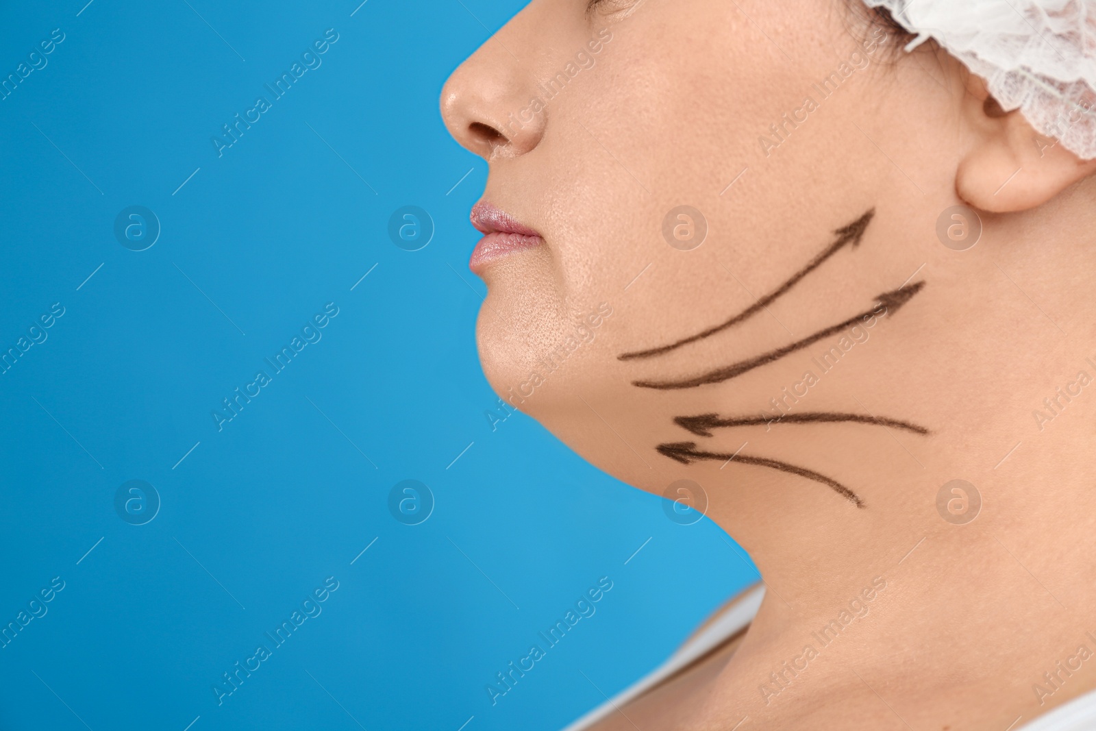 Photo of Woman with double chin ready for cosmetic surgery operation on blue background, closeup