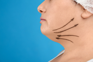 Woman with double chin ready for cosmetic surgery operation on blue background, closeup