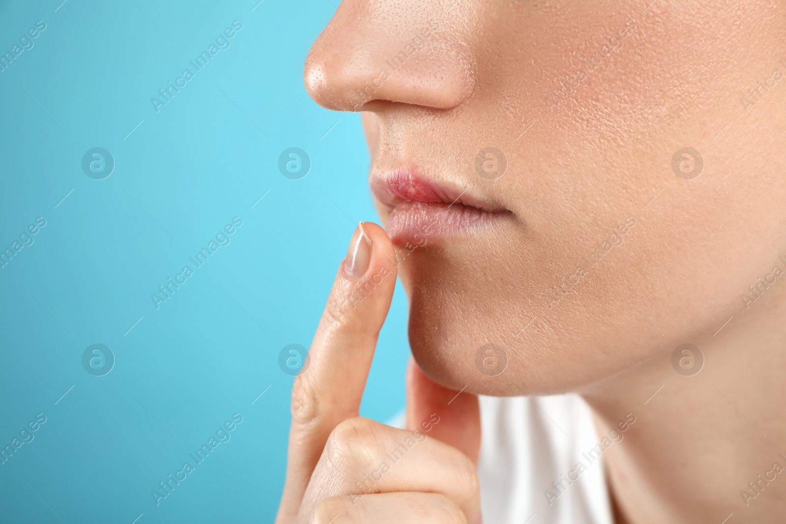 Photo of Woman suffering from herpes on light blue background, closeup. Space for text