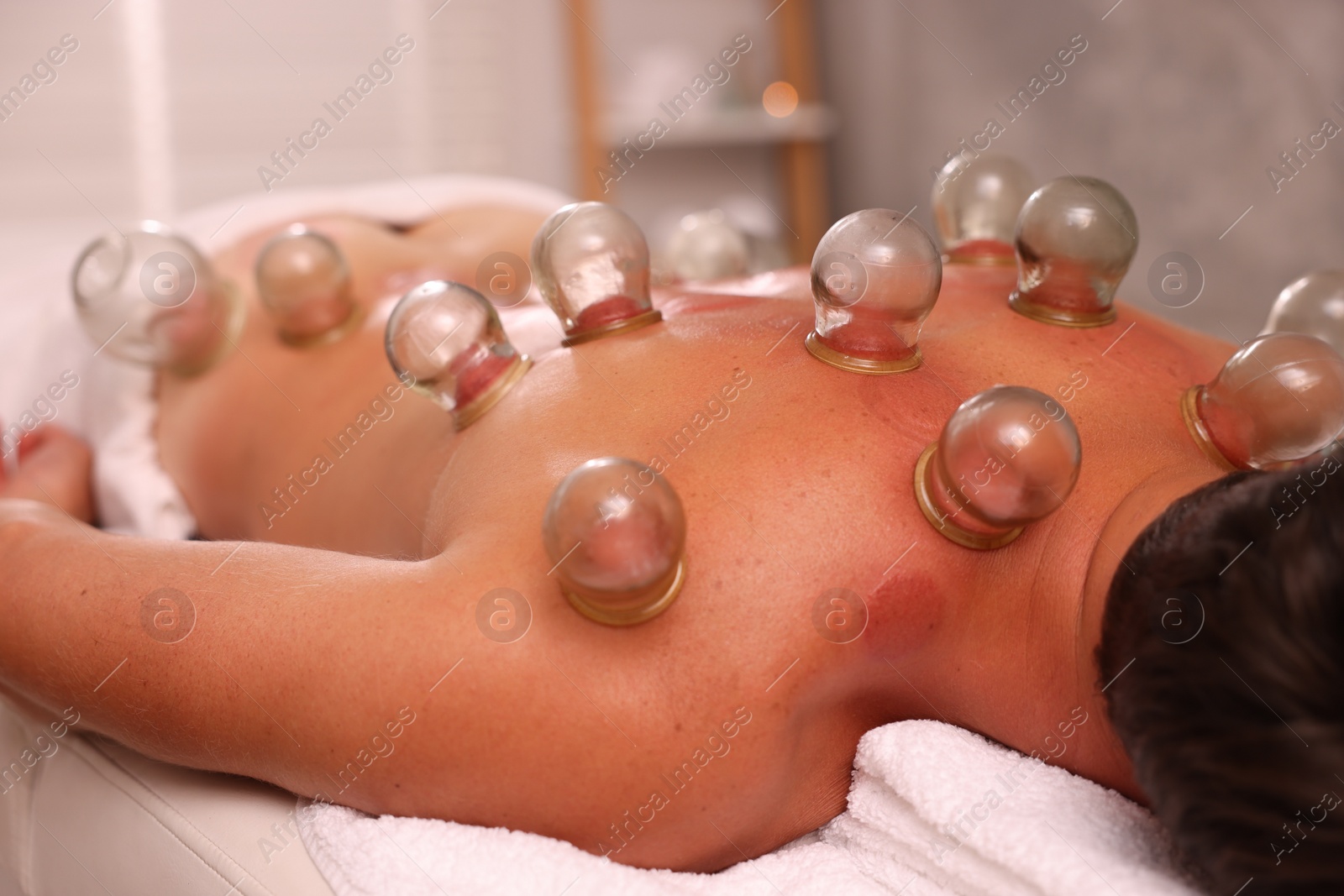 Photo of Cupping therapy. Closeup view of man with glass cups on his back in spa salon