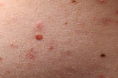 Young person with acne problem, closeup view of skin