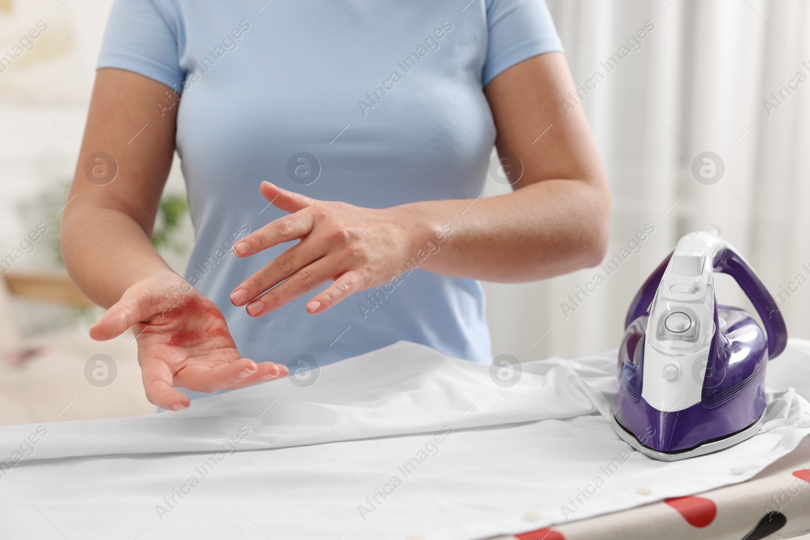 Photo of Woman with burns on her hand near iron and board indoors, closeup