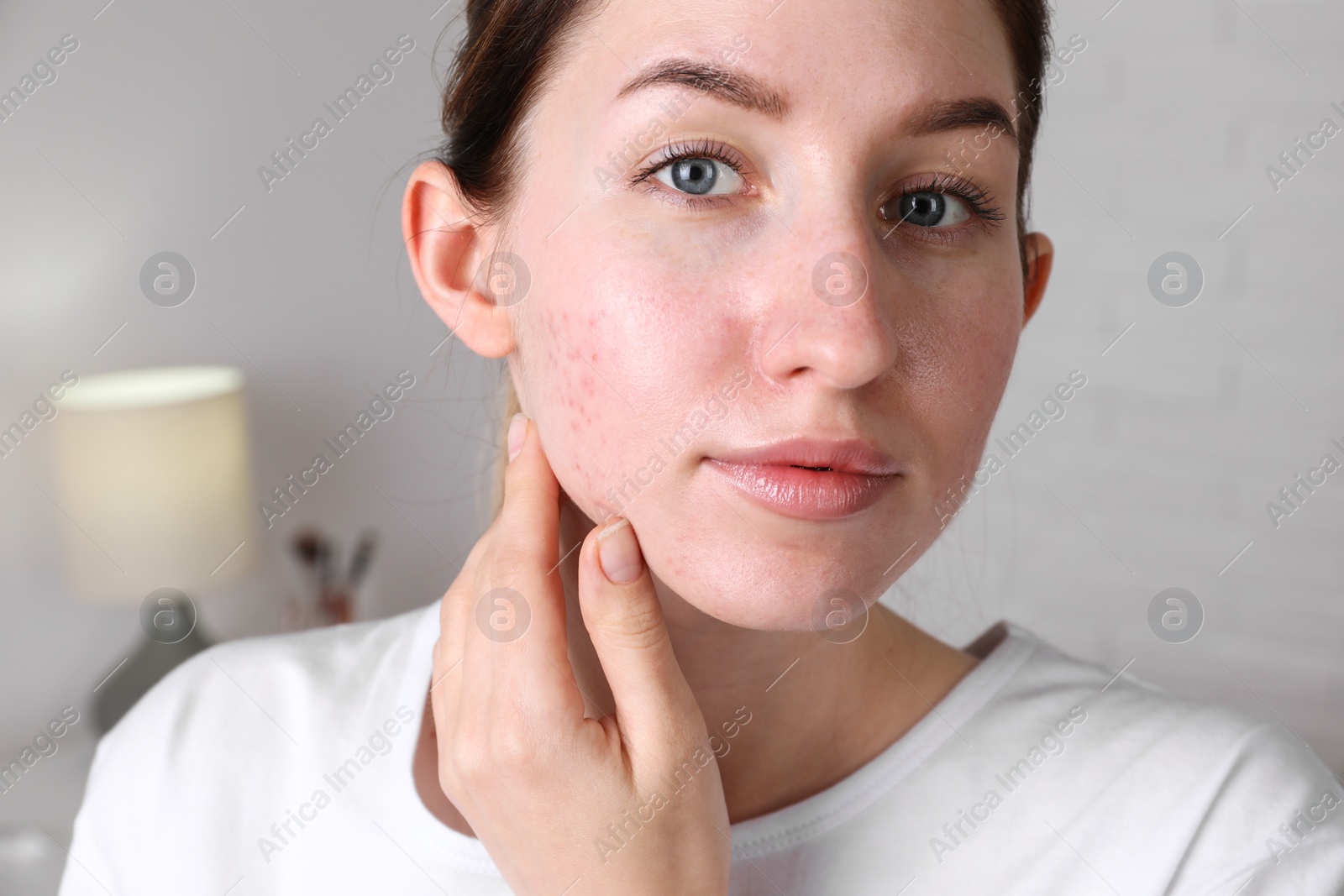 Photo of Young woman with acne problem at home